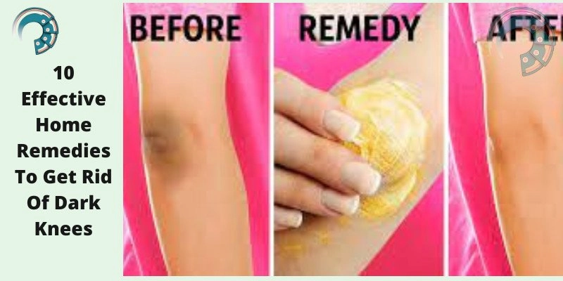 10 Effective Home Remedies To Get Rid Of Dark Knees