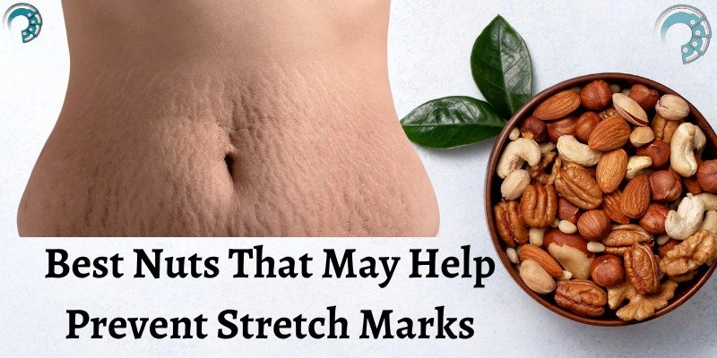 Best Nuts That May Help Prevent Stretch Marks