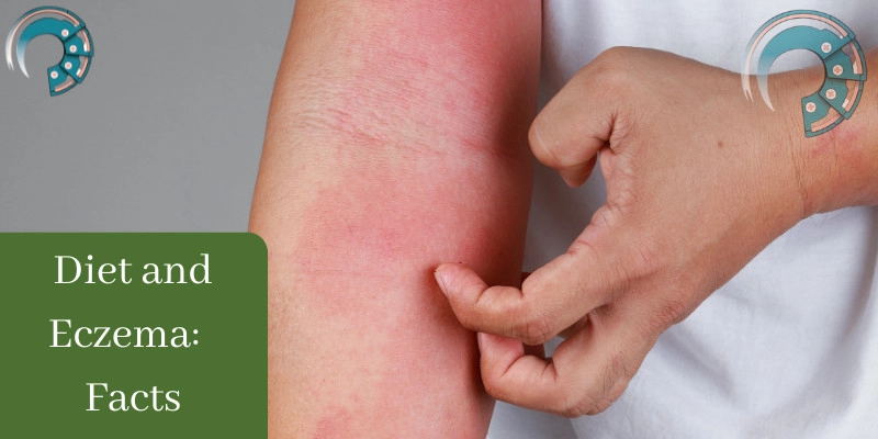 Diet and Eczema:  Facts